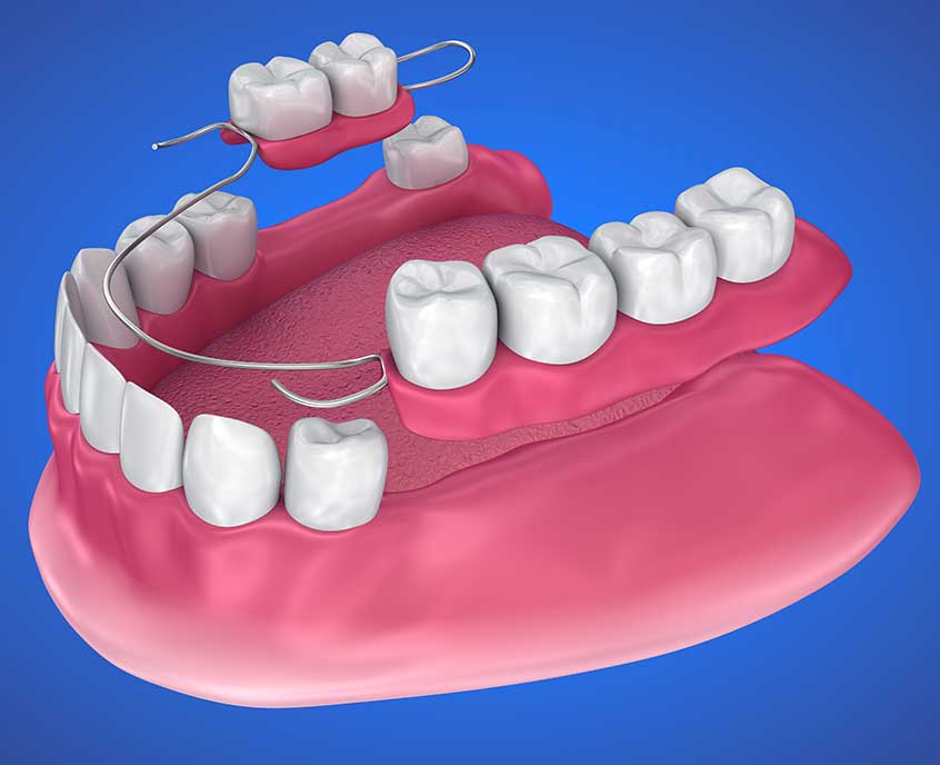 Dentures and Partial Dentures San Francisco Image
